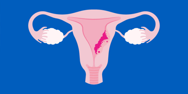 Prevén futuro alentador en terapias para cáncer de endometrio