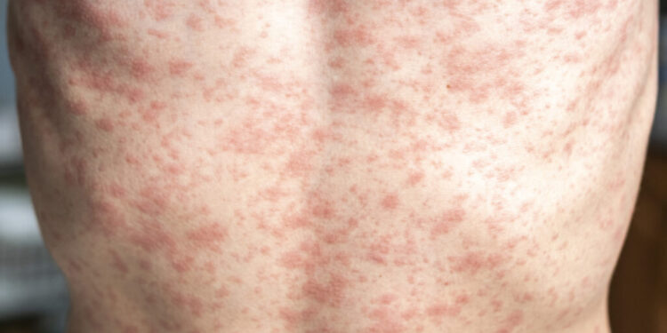 Suben a mil 520 los casos de sarampión en México: ¿cuáles son los estados más afectados?