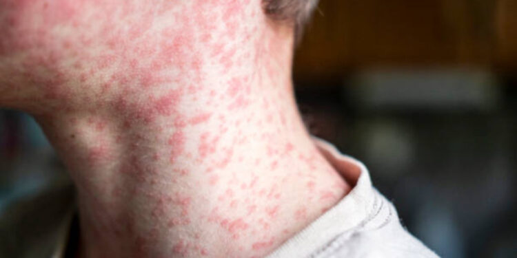 Reportan mil 789 casos y cinco muertes por sarampión en México: estos son los estados más afectados