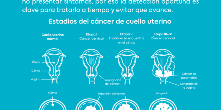 Día Mundial del Cáncer de Cuello Uterino: prevenir puede hacer la diferencia