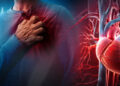 Detectar la aterosclerosis a tiempo puede prevenir un infarto